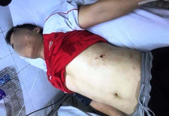 Một nam thanh niên trúng đạn ở phần bụng được đưa vào bệnh viện cấp cứu
